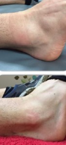Before After Ankle